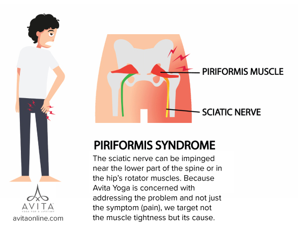 Piriformis Syndrome Avita Yoga The sciatic nerve can be impinged near the lower part of the spine or in the hip’s rotator muscles. Because Avita Yoga is concerned with addressing the problem and not just the symptom (pain), we target not the muscle tightness but its cause. Too much sitting!