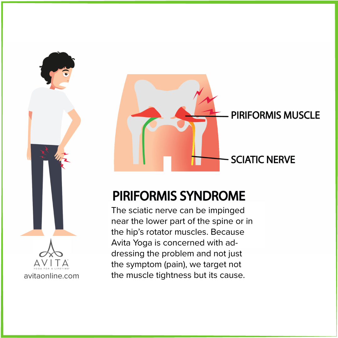 Piriformis Syndrome Avita Yoga The sciatic nerve can be impinged near the lower part of the spine or in the hip’s rotator muscles. Because Avita Yoga is concerned with addressing the problem and not just the symptom (pain), we target not the muscle tightness but its cause. On Demand Yoga